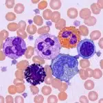 Globules rouges et cellules blanches anormales au microscope